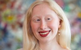 Türkiye’de sadece 3-4 bin kişide var! “‘Ay o ne öyle çok kötü’ diyen oluyor”